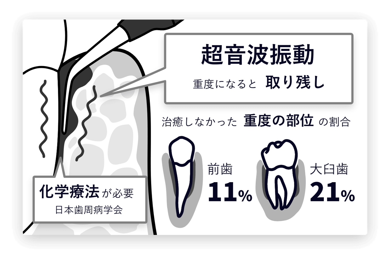 超音波振動のみ