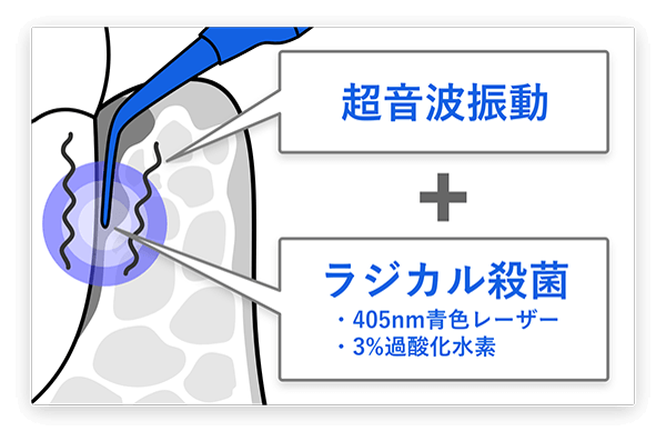 超音波振動 + ラジカル殺菌